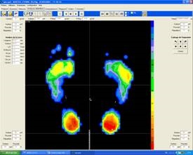 Analyse sur plate-forme de force 02 Examen clinique