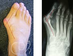 Hallux Valgus Hallux valgus