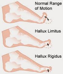 Hallux rigidus Hallux rigidus