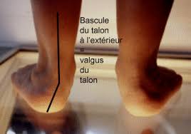 Pied valgus Pied Valgus