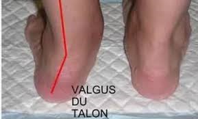 valgus Pied Valgus