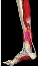 La périostite tibiale La périostite tibiale