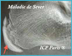 Maladie de Sever 02 Maladie de Sever