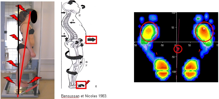Surpoid et pathologie du pied