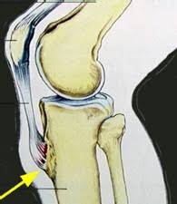 maladie d’Osgood-Schlatter maladie d’Osgood-Schlatter